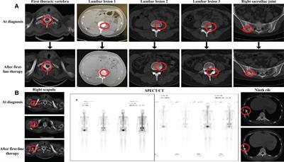 Pseudoprogression after advanced first-line endocrine therapy in metastatic breast cancer with bone metastasis: A case report